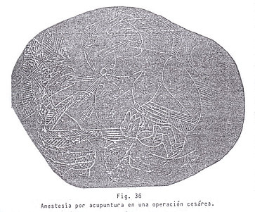 Fig. 36: Anestesia con acupuntura
                en una operaci�n de ces�rea
