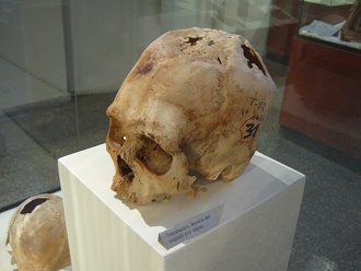 Drilled skull 02