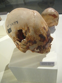 Drilled skull 04