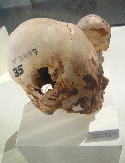 Drilled skull 04, second photo