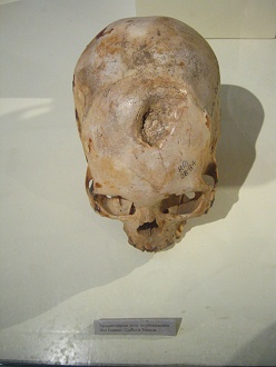 Drilled skull 05, healed over