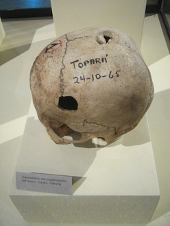 Drilled skull 06