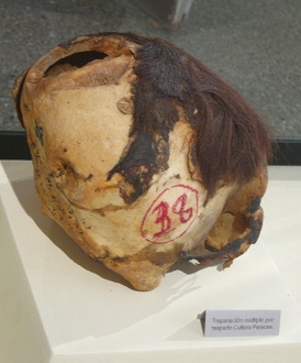 Skull drilled several times